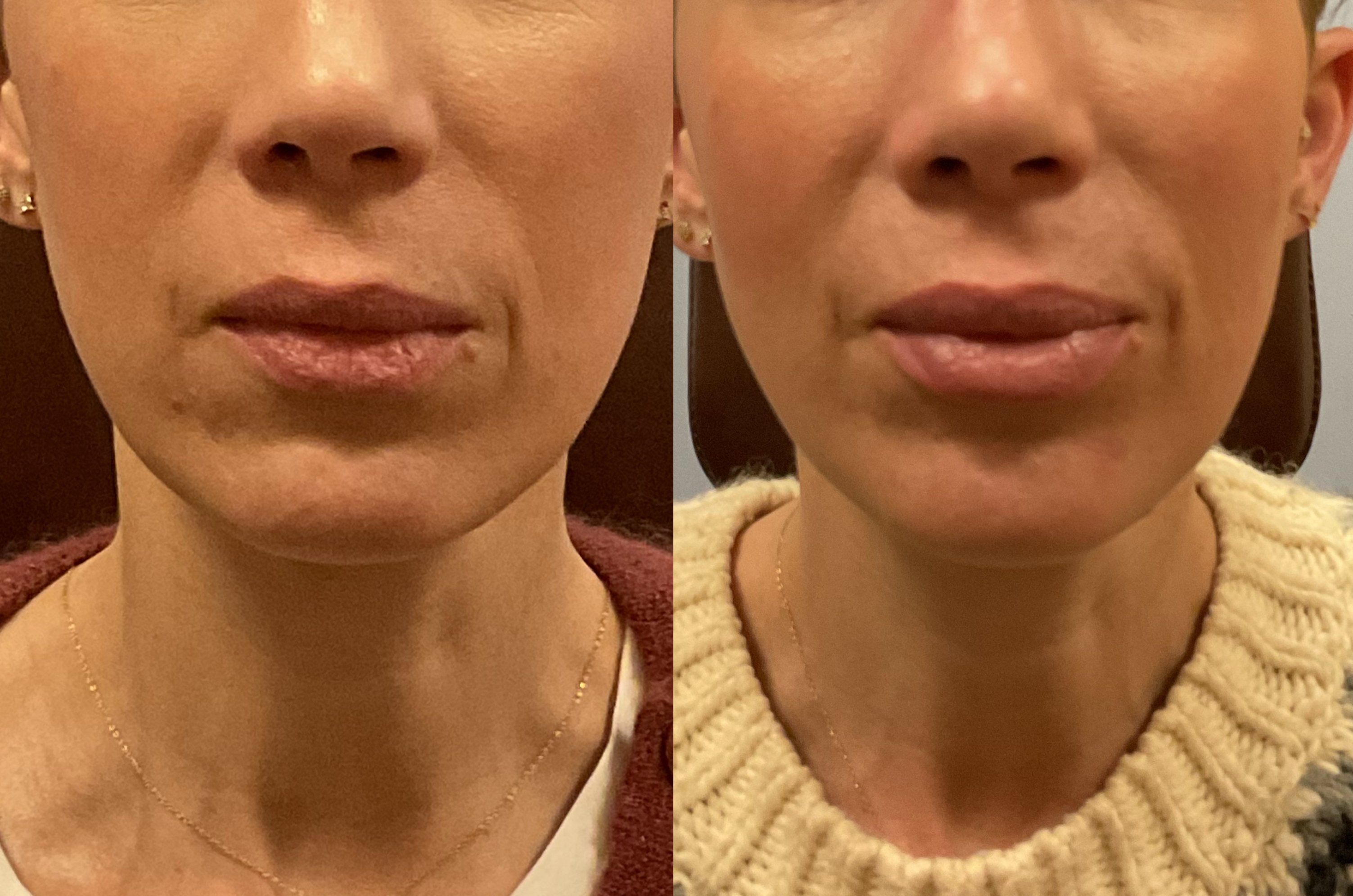 the-cost-of-botox-fillers-jcandtim